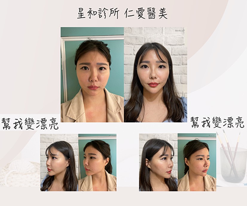 【肉毒桿菌】
